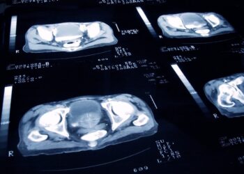 IA usada por pesquisadores para revelar que o câncer de próstata não é apenas uma doença