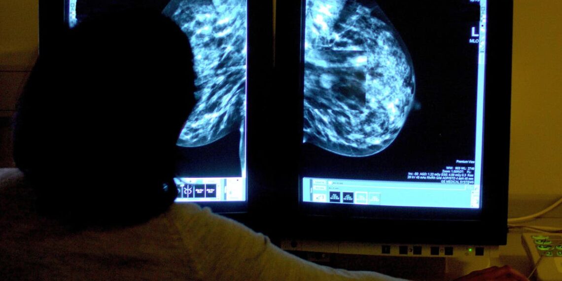 Avanço de medicamentos pode ajudar pessoas com genes defeituosos a evitar cirurgia de câncer de mama