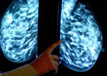 Relatório sugere que pessoas com câncer de mama estão sendo “sistematicamente deixadas para trás”