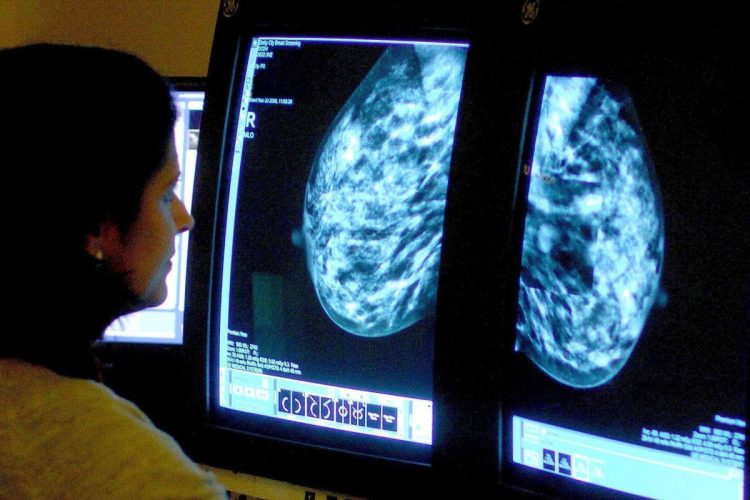Sobreviventes de cancer de mama tem alto risco de desenvolver