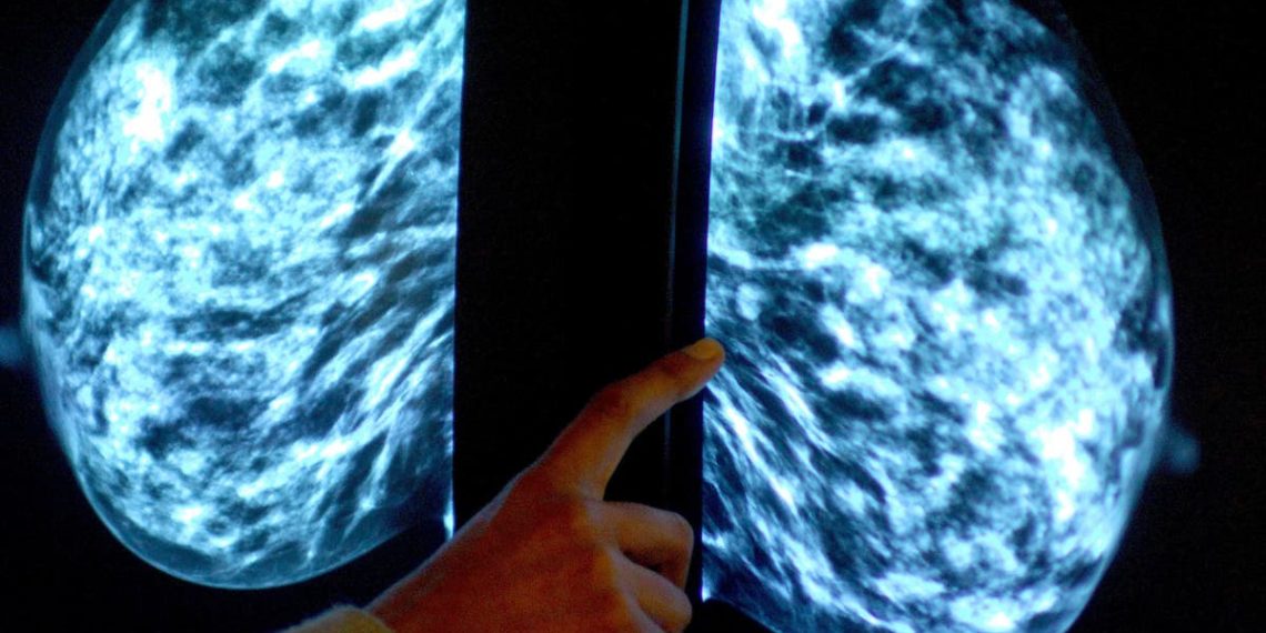Descoberta de células imunológicas 'poderia levar a tratamento personalizado para câncer de mama'