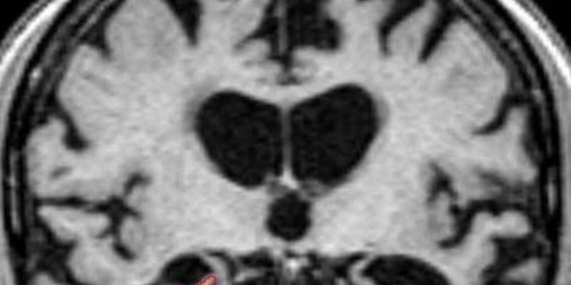 Cientistas revelam estudo sobre se você herda Alzheimer do lado materno ou paterno