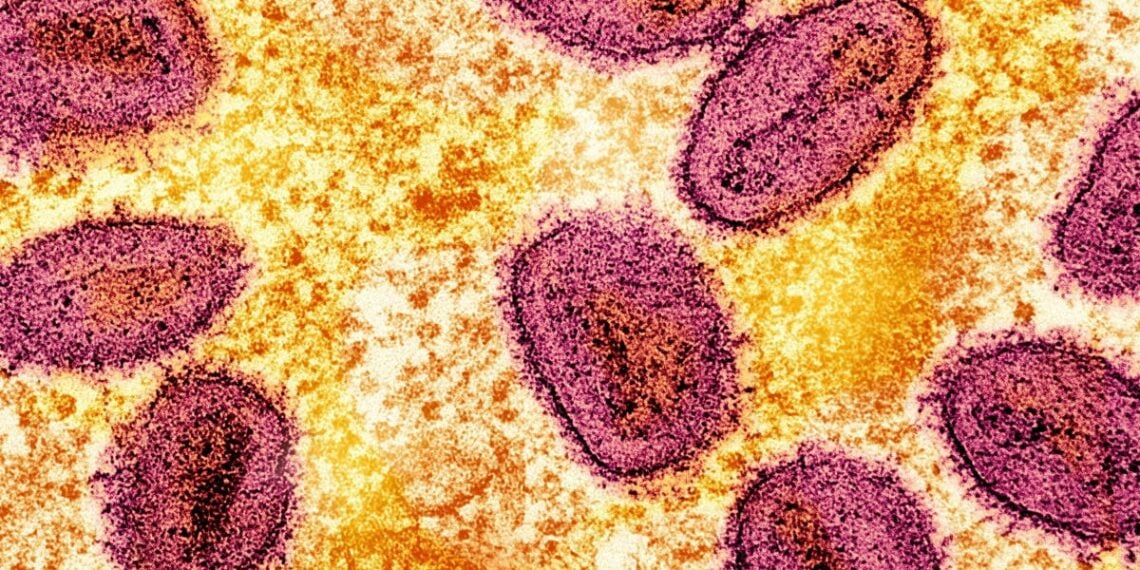 Primeiro caso de nova cepa mpox potencialmente mortal, Clade 1b, detectado no Reino Unido